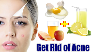  5 ways to get rid of acne Overnight