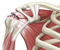 rotator cuff tear