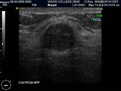 gallbladder stones ultrasound images. Ultrasound showed a 1.5cm