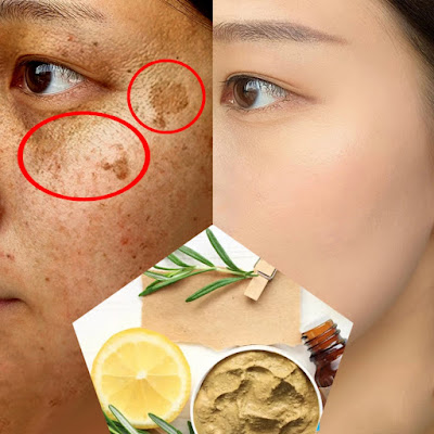 6 Ingrédients naturels pour éclaircir les taches brunes du visage