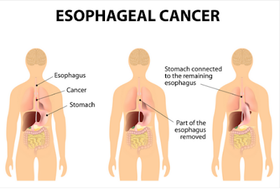 esophageal cancer surgery in india