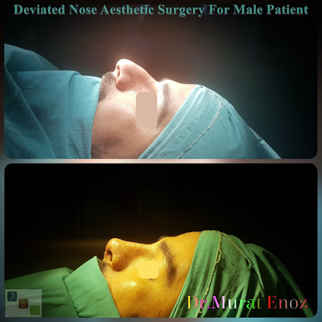 Deviated Nose Aesthetic Surgery, Asymmetric Nose Correction Operation,Rhinoplasty in Men Istanbul,