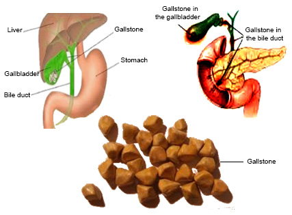 Gallstones: Causes, Symptoms, Test and Treatment.