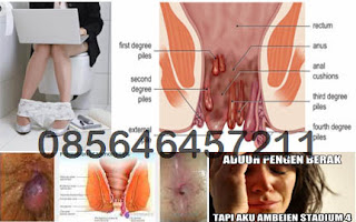 Cara Mengempeskan Benjolan Wasir (Hemoroid) di Anus