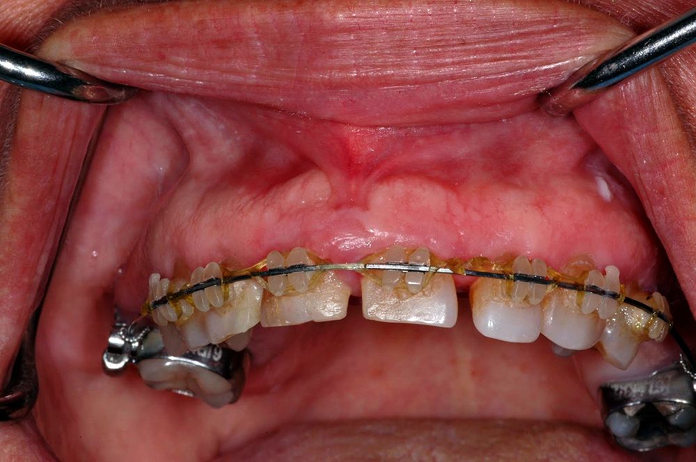 Periodontics-Orthodontics