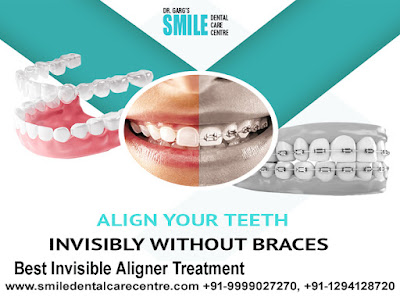 Best Invisible Aligner Treatment