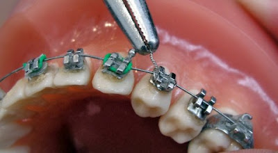 Niềng răng hô nhẹ có ưu điểm gì?