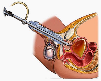Аденома предстательной железы после операции