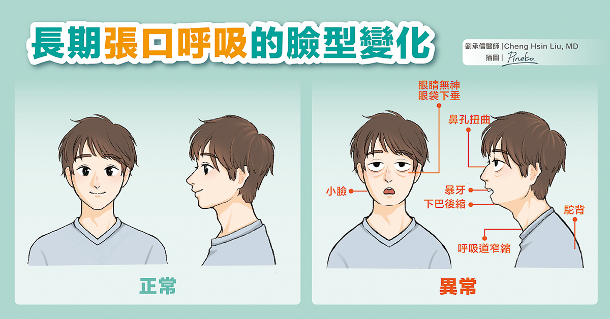 長期用嘴巴呼吸的人會改變臉型並增加蛀牙矯正與植牙的風險、影響睡眠則會有注意力不集中與增加心血管腦部疾病的風險、經口呼吸也會降低肺部支氣管的免疫力。