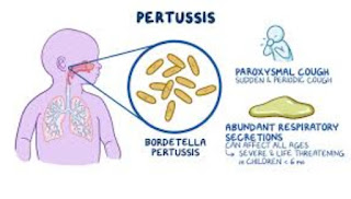 Pertussis, Pertussis Adalah, Gejala Awal Pertussis, Pertussis Pada Bayi, Diagnosa Pertussis, Pencegahan Pertussis