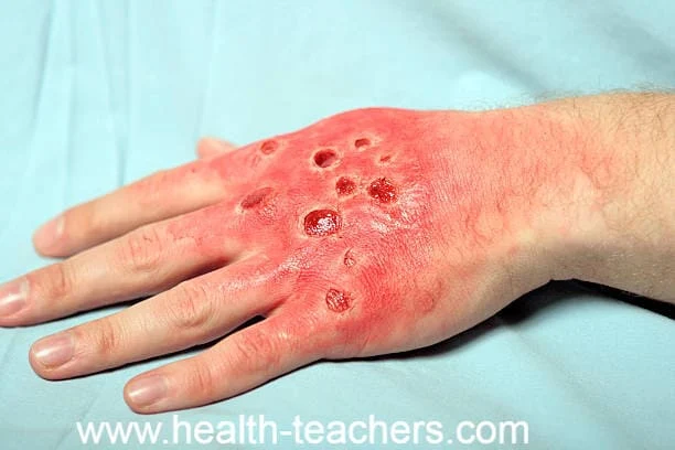 Hand and foot diseases! - Health-Teachers