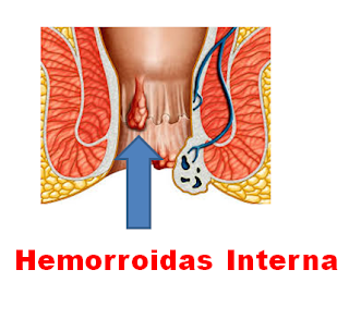  ImagemHemorroidaInterna