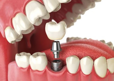  Dental Implant