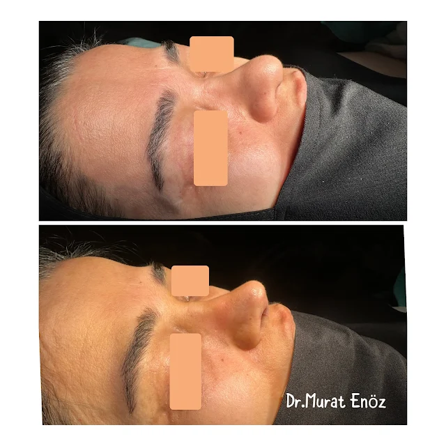 Pollybeak Deformity,Parrot Beak Deformity,Polly beak deformity,Polly-beak nose deformity,Revision rhinoplasty