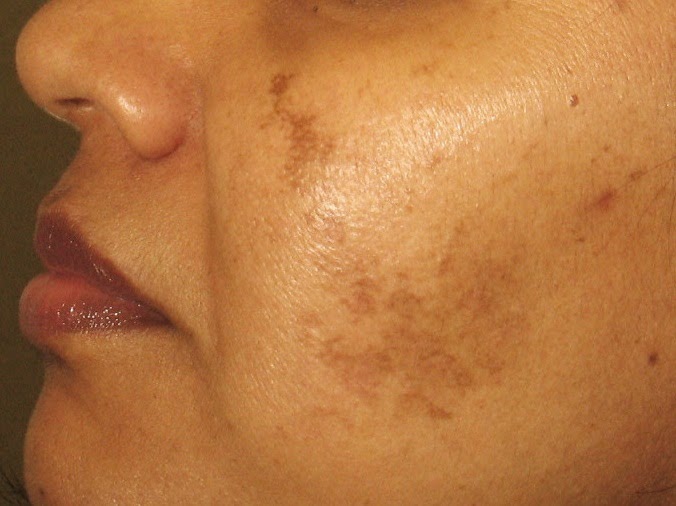 Skin Problems solutions for Acne,Age or liver spots,Scars 
