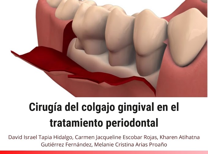 PDF: Cirugía del colgajo gingival en el tratamiento periodontal
