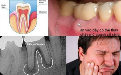 Sưng chân răng không đau là gì?