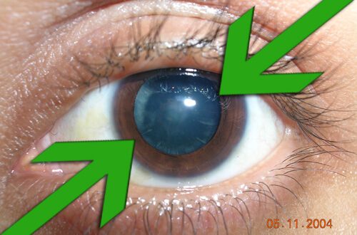  Katarak ialah kekeruhan dan kerusakan lensa mata akhir penebalan yang biasanya terjadi  Luar Biasa! Katarak Sembuh Tanpa Operasi Dengan Meneteskan Minyak Jarak (Castor Oil)