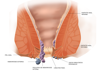 Hemorrhoids treatment: Are Hemorrhoids Treatable?