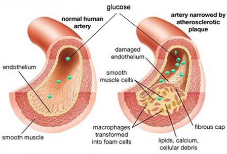 Atherosklerosis pada Penderita Diabetes (Sumber Gambar: http://momega.com.au/)