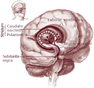  penyakit parkinson ialah penyakit saraf kronis yang berkembang orang orang yang lanjut u Tahukah Anda, Apa Penyakit Parkinson itu?