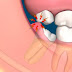 Biến chứng nguy hiểm khi răng khôn mọc lệch hàm dưới