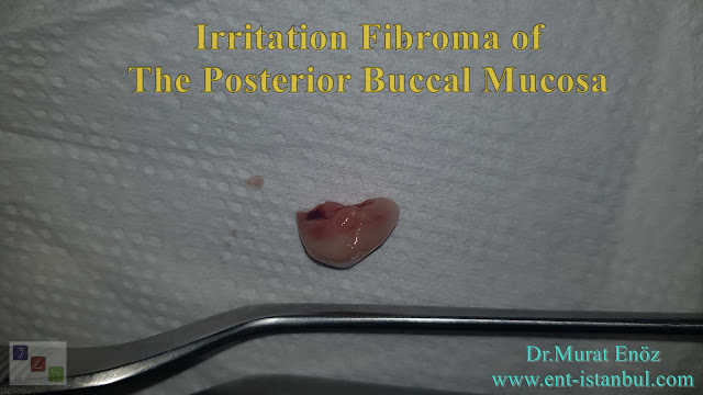 irritation fibroma, irritable fibroma, traumatic fibroma, fibrous hyperplasia, focal fibrous hyperplasia, localized fibrous hyperplasia, fibrous polyps, fibrous nodules, fibroepithelial polyps