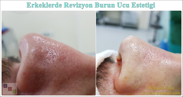 Revizyon burun ucu estetiği ameliyatı - Revizyon burun ucu estetiği operasyonu - Revizyon burun ucu ameliyatı fotoğrafları - Revizyon tipplasti operasyonu fotoğrafları