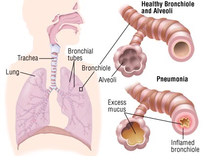 Impaired Gas Exchange related to Pneumonia