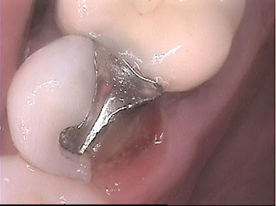 smile-sydney-dentist-a-crown-restores-the-enamel-of-a-fractured-tooth