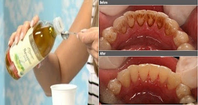 Say Goodbye To Bad Breath, Plaque, Tartar And Kill Harmful Bacteria In Your Mouth With Only One Ingredient!