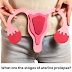 What are the stages of uterine prolapse?