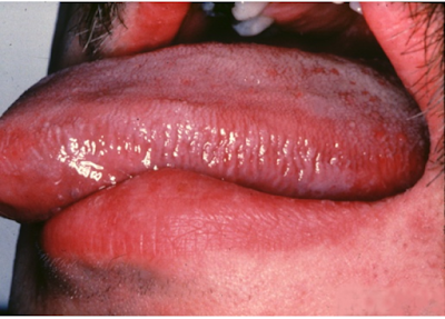 Oral Hairy Leukoplakia’(OHL)