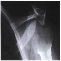 trauma shoulder