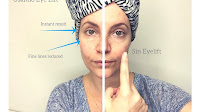 Blepharoplasty - Eye Lift