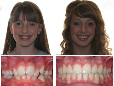 Hiệu quả niềng răng cho trẻ em từ lúc thay răng cho tới khi trưởng thành