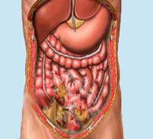  Nursing Management for Peritonitis