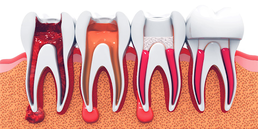 Endodontik Tedavi Nedir