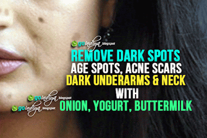 Remove Dark spots, Age spots, Acne scars, Dark underarms & Neck - Onion, Yogurt, Buttermilk Magic!