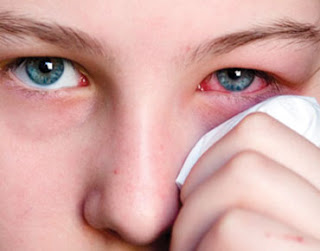     حساس بالحكة     إحمرار وتورم في الملتحمة      زيادة الإفرازات المخاطية      الإحساس بالجفاف في العين.     زياده في افراز الدموع.