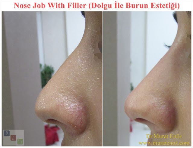 Non-surgical nose job, Nose filler injection Istanbul, Liquid rhinoplasty, Nose camouflage with filler, Nose reshaping with filler