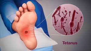 Tetanus (infeksi bakteri yang menyebabkan otot kejang)