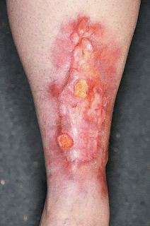 Necrobiosis Lipoidica Diabeticorum