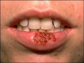 Oral herpes such as cold sores