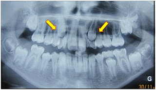 17.Radiographie panoramique montrant l’agénésie des 12 et 22