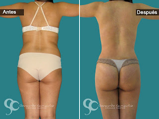 fotos-abdominoplastia 