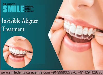 Best Invisible Aligner Treatment in Faridabad