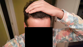 6 months after fue hair transplant frontal