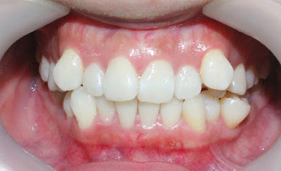 Niềng răng khấp khểnh mất bao lâu thì hoàn tất?