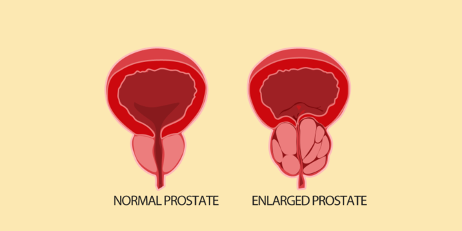 Apa itu Prostat, dan Apa Fungsinya Bagi Pria?